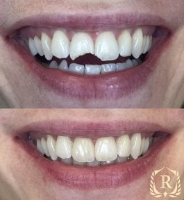 Before and after smile makeover at Rosental Dental – chipped teeth restoration results