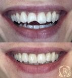Before and after smile makeover at Rosental Dental – chipped teeth restoration results