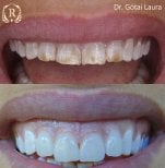 Résultat avant/après smile makeover chez Rosental Dental – couleur et alignement améliorés