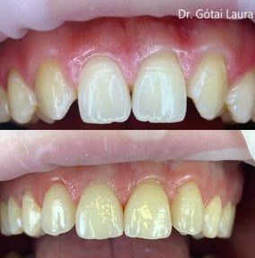 Before and after smile makeover at Rosental Dental – improved tooth shape and gum line result