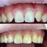 Before and after smile makeover at Rosental Dental – improved tooth shape and gum line result