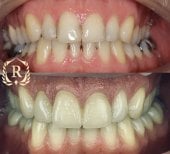 Before and after smile makeover at Rosental Dental – improved teeth alignment and color result
