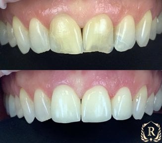 Résultat avant/après smile makeover chez Rosental Dental – couleur et alignement améliorés