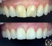 Résultat avant/après smile makeover chez Rosental Dental – couleur et alignement améliorés