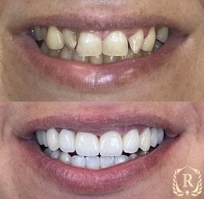 Résultats avant/après smile makeover chez Rosental Dental – alignement et couleur améliorés