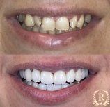 Résultats avant/après smile makeover chez Rosental Dental – alignement et couleur améliorés