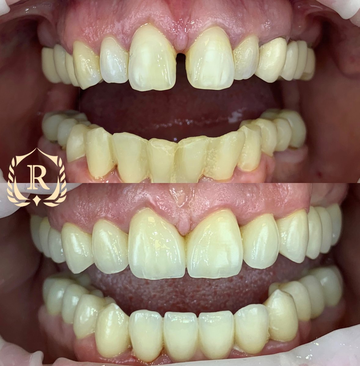 Antes y después de smile makeover en Rosental Dental – alineación dental y cierre de espacios