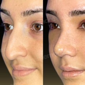 Before and after ultrasonic rhinoplasty result at Memorial Şişli Hospital, nose reshaping