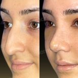Before and after ultrasonic rhinoplasty result at Memorial Şişli Hospital, nose reshaping