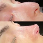 Before and after ultrasonic rhinoplasty results at Memorial Şişli Hospital, nose reshaping