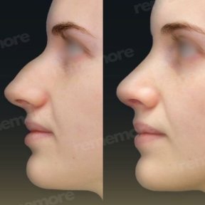 Before and after ultrasonic rhinoplasty results at Memorial Şişli Hospital, nose reshaping
