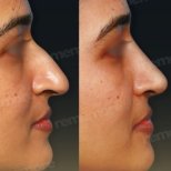 Before and after ultrasonic rhinoplasty results at Memorial Şişli Hospital, nose reshaping
