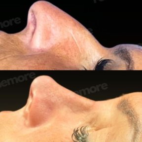 Before and after ultrasonic rhinoplasty result at Memorial Şişli Hospital, nose reshaping