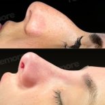 Before and after ultrasonic rhinoplasty result at Memorial Şişli Hospital, nose reshaping