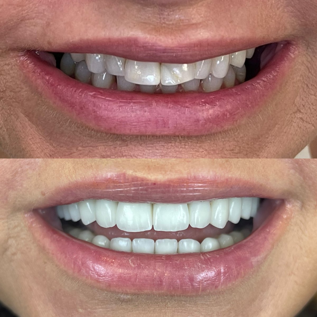 Antes y después de carillas Hollywood Smile en Rosental Dental – dientes blancos y parejos