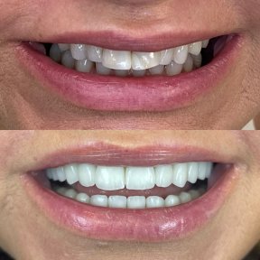 До и после виниров Hollywood Smile в Rosental Dental – белые, ровные зубы результат