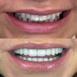 До и после виниров Hollywood Smile в Rosental Dental – белые, ровные зубы результат