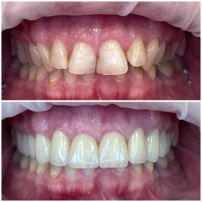 До и после виниров Hollywood Smile в Rosental Dental – заметное преображение улыбки