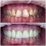 До и после виниров Hollywood Smile в Rosental Dental – заметное преображение улыбки
