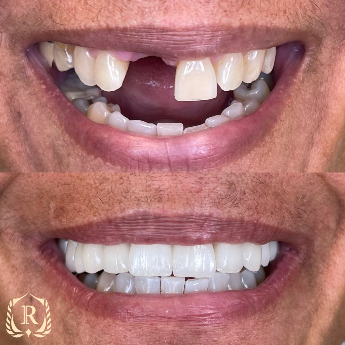 До та після Hollywood Smile у Rosental Dental – результат повного відновлення усмішки