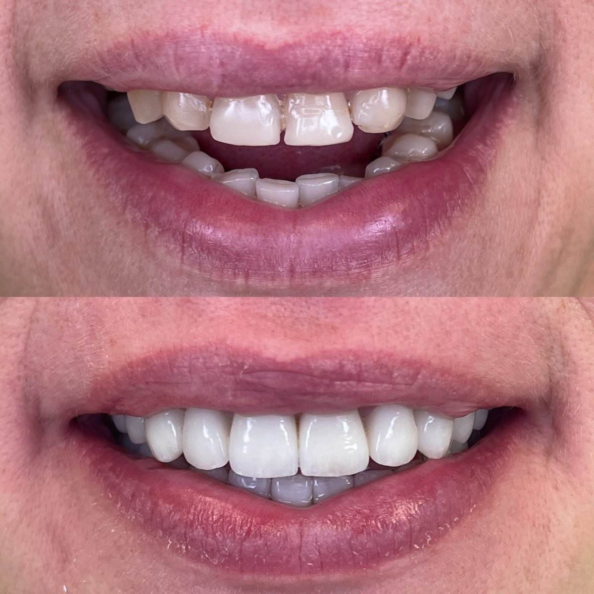 До і після Hollywood Smile у Rosental Dental – перетворення посмішки вінірами