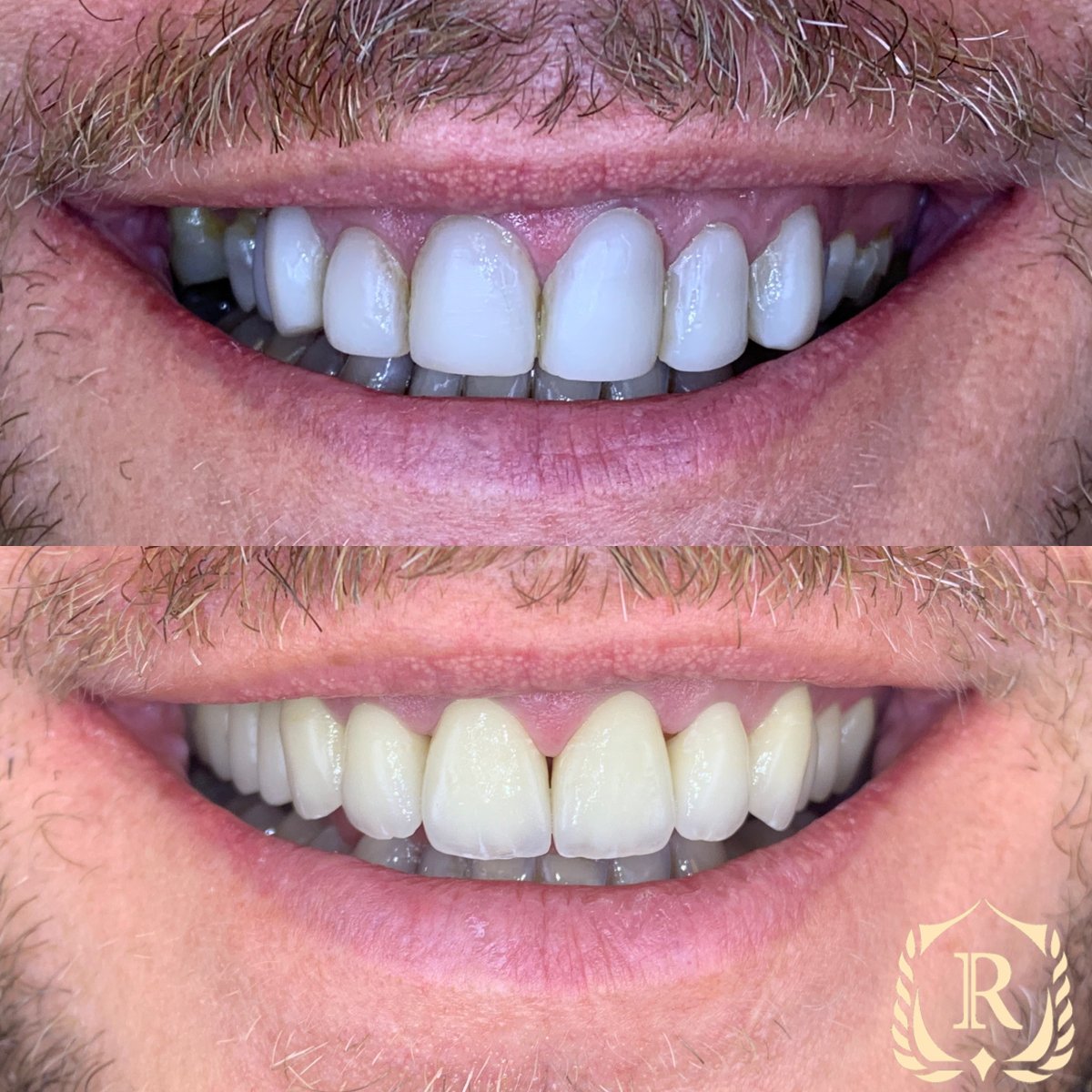До та після Hollywood Smile у Rosental Dental – покращена естетика зубів