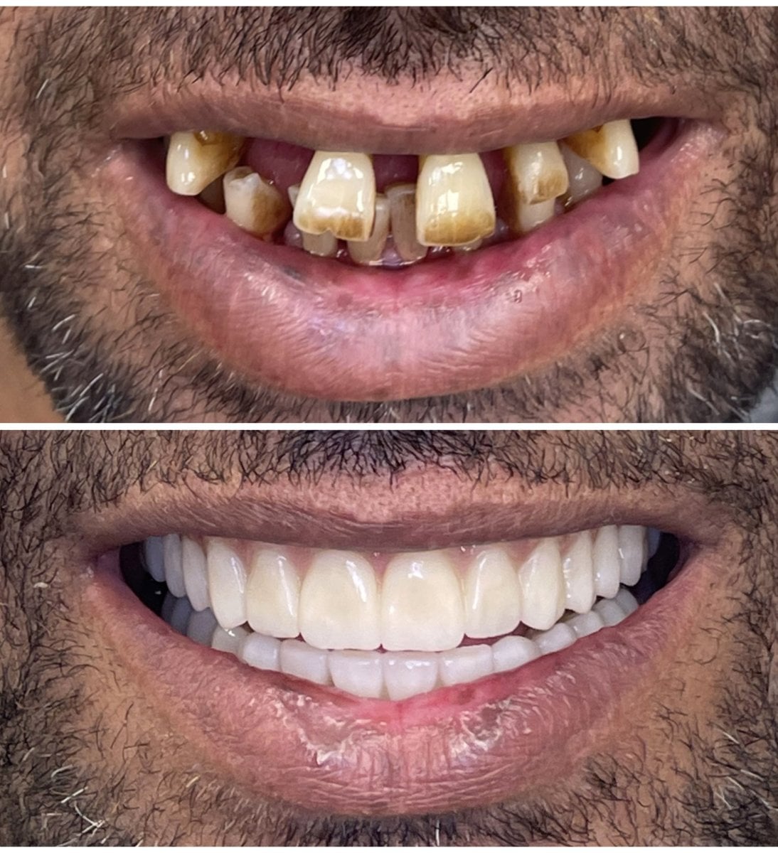 Resultados antes y después de implantes All-on-6 en Rosental Dental – restauración total de sonrisa