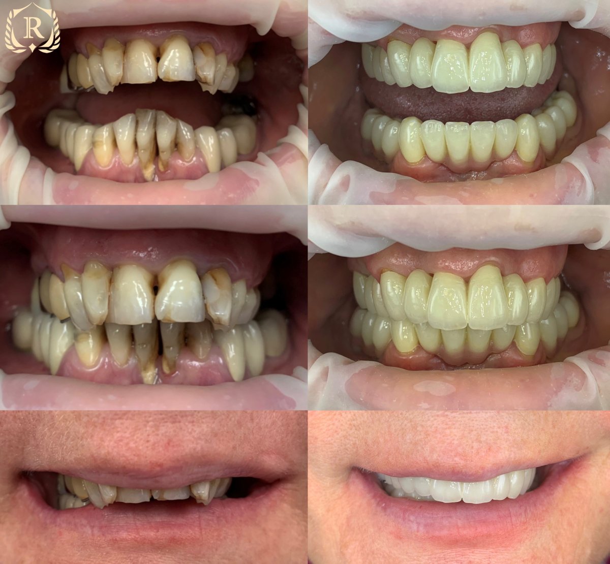 Resultados antes y después de implantes dentales All-on-6 en Rosental Dental – restauración total