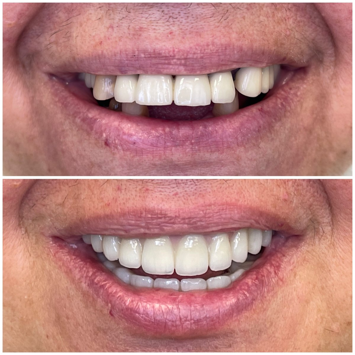 نتيجة قبل وبعد زراعة الأسنان All-on-6 في Rosental Dental – ابتسامة مستعادة