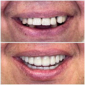 Vorher-nachher-Ergebnis All-on-6-Implantate bei Rosental Dental – neues Lächeln