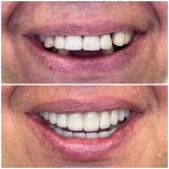 Vorher-nachher-Ergebnis All-on-6-Implantate bei Rosental Dental – neues Lächeln