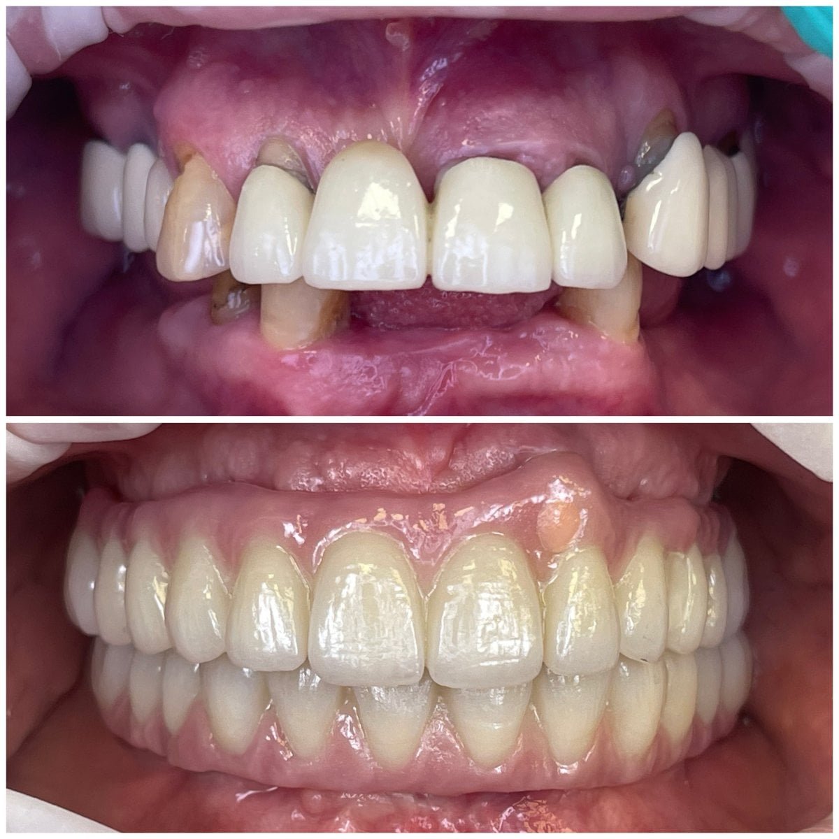Resultados antes y después de implantes dentales All-on-6 en Rosental Dental – sonrisa restaurada