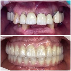 Before and after All-on-6 dental implants result at Rosental Dental – full smile restoration