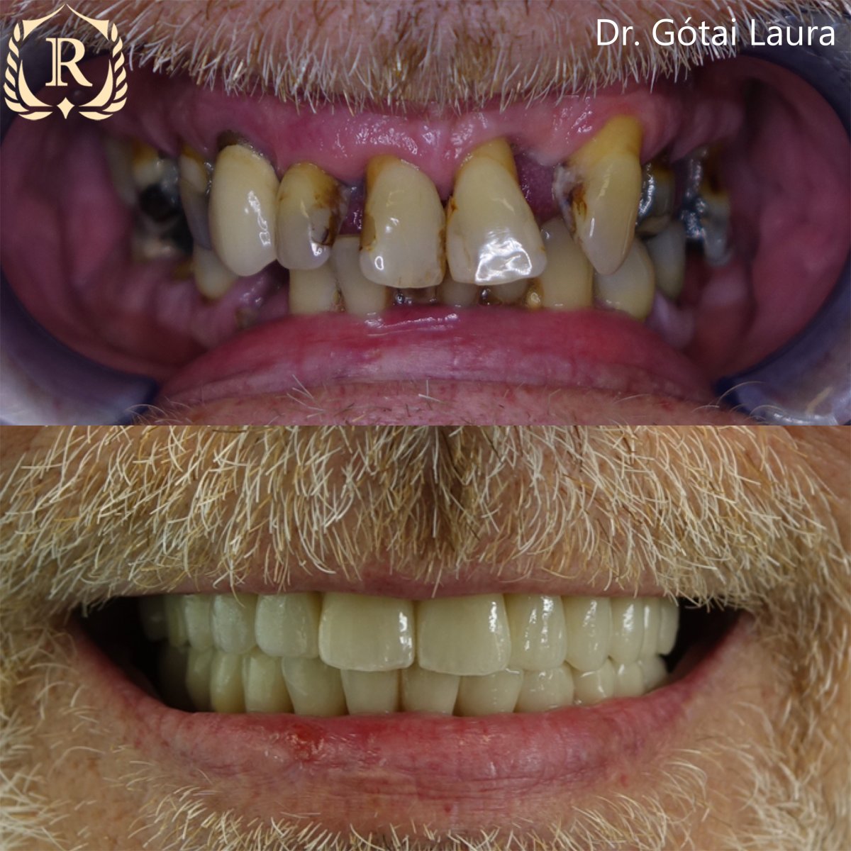قبل وبعد زراعة الأسنان All-on-6 في Rosental Dental – نتيجة استعادة الابتسامة الكاملة