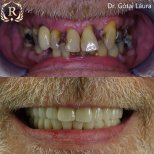 До та після імплантації All-on-6 у Rosental Dental – результат повного відновлення посмішки