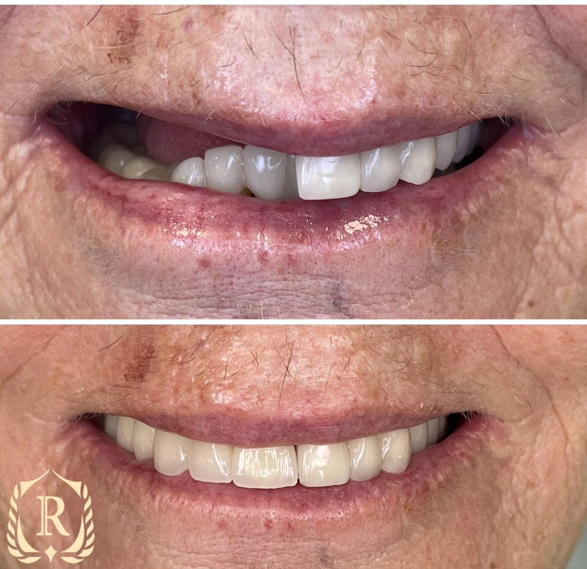 Résultat avant-après implants All-on-6 chez Rosental Dental, sourire amélioré