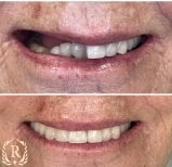 Résultat avant-après implants All-on-6 chez Rosental Dental, sourire amélioré