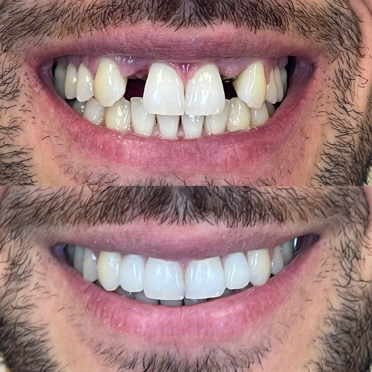 Résultat avant/après implants All-on-6 chez Rosental Dental – sourire restauré
