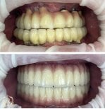 Résultat avant/après implants All-on-6 chez Rosental Dental – restauration complète du sourire