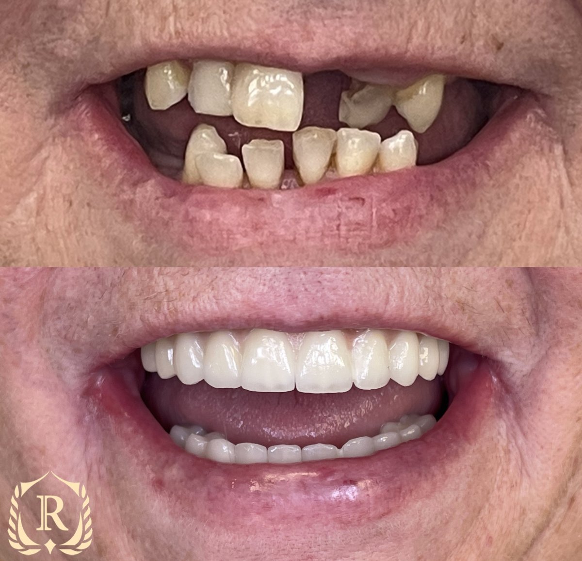 Résultat avant/après implants All-on-6 chez Rosental Dental – restauration complète du sourire