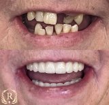 Résultat avant/après implants All-on-6 chez Rosental Dental – restauration complète du sourire