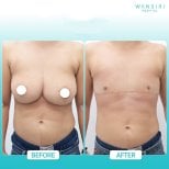 Before and after top surgery results at Wansiri Hospital, chest masculinization transformation