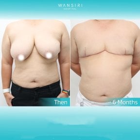 Before and after top surgery results at Wansiri Hospital, chest masculinization outcome