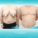 Before and after top surgery results at Wansiri Hospital, chest masculinization outcome