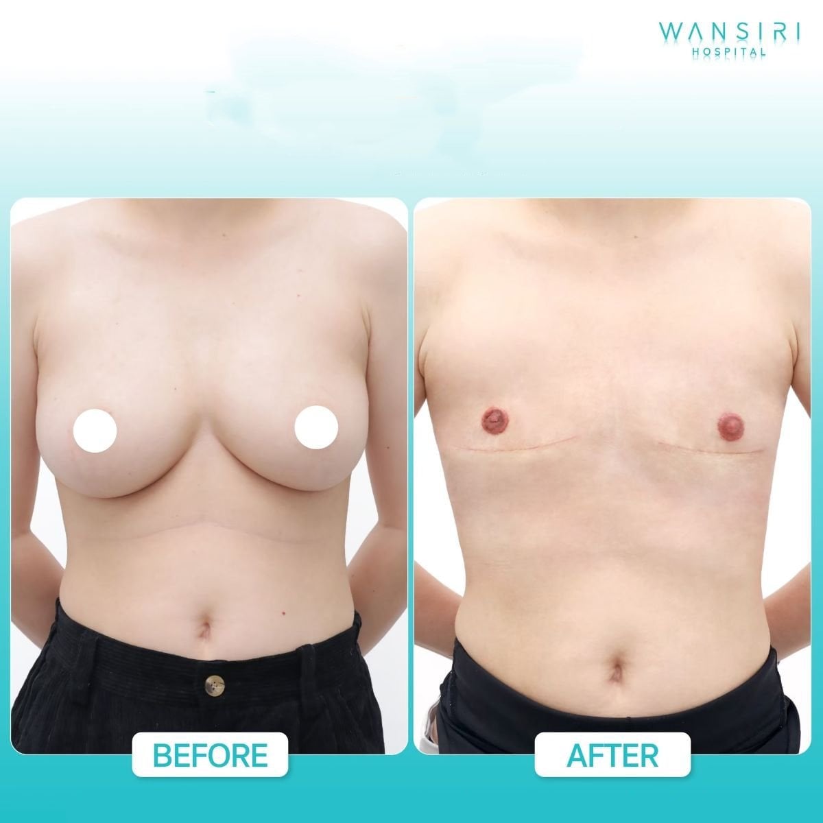 Resultados de top surgery antes y después en Wansiri Hospital, masculinización torácica
