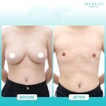 Before and after top surgery results at Wansiri Hospital, chest masculinization procedure