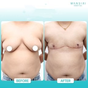 Before and after top surgery results at Wansiri Hospital, chest masculinization procedure