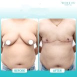 Before and after top surgery results at Wansiri Hospital, chest masculinization procedure