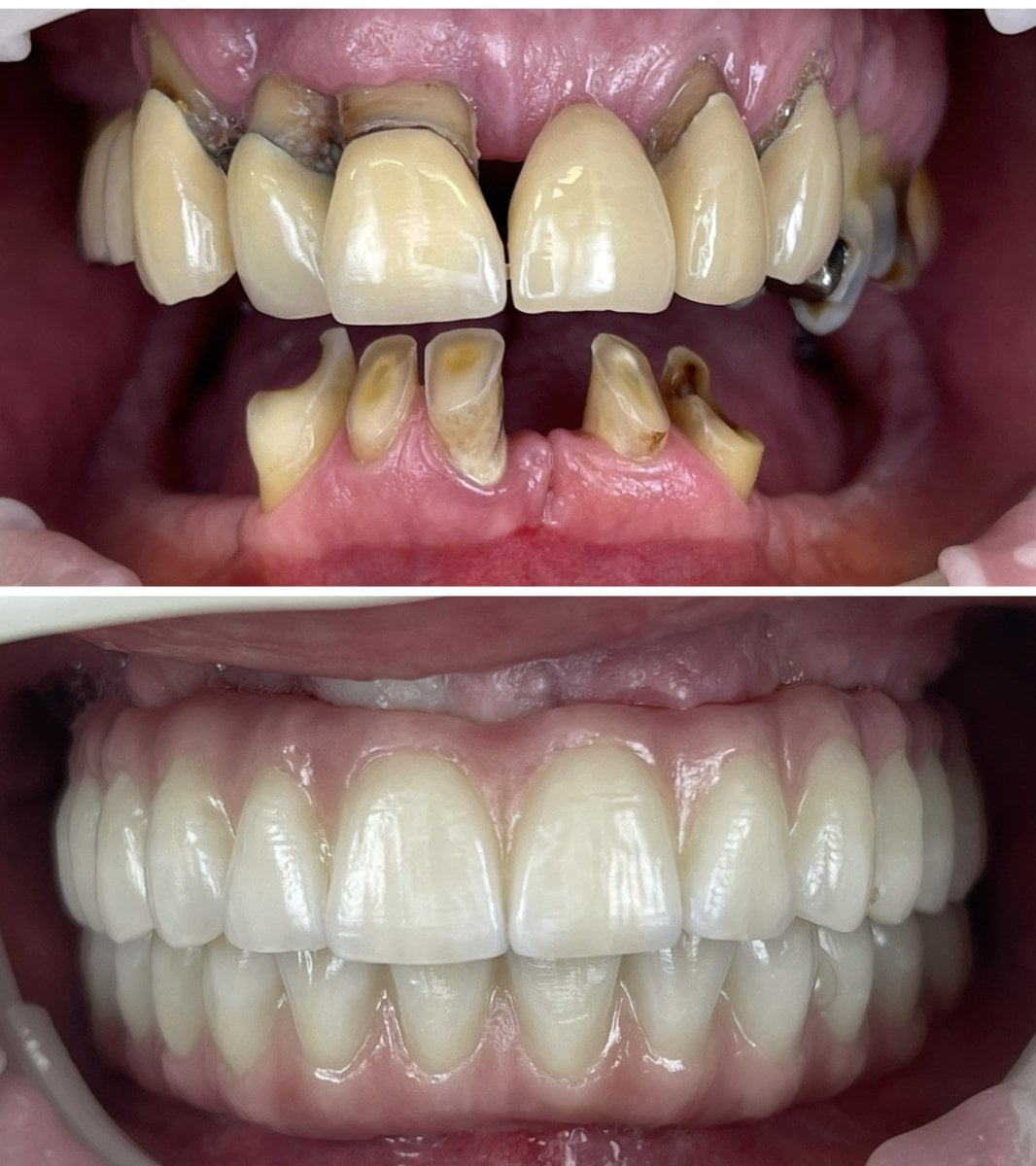 Resultados antes y después de implantes All-on-4 en Rosental Dental – restauración total de sonrisa