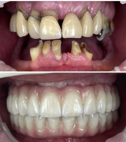 Результат до та після імплантації All-on-4 у Rosental Dental – відновлення посмішки
